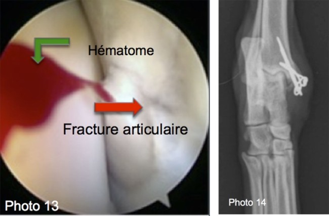 Fractures de l<span data-charcode=