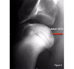 Ostéochondrite de l epaule